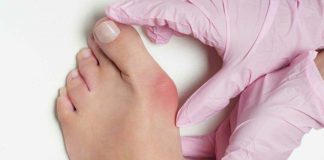 5 Ways to Treat Bunion without surgery